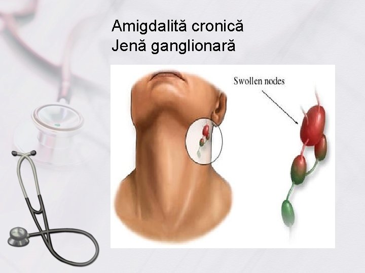 Amigdalită cronică Jenă ganglionară 