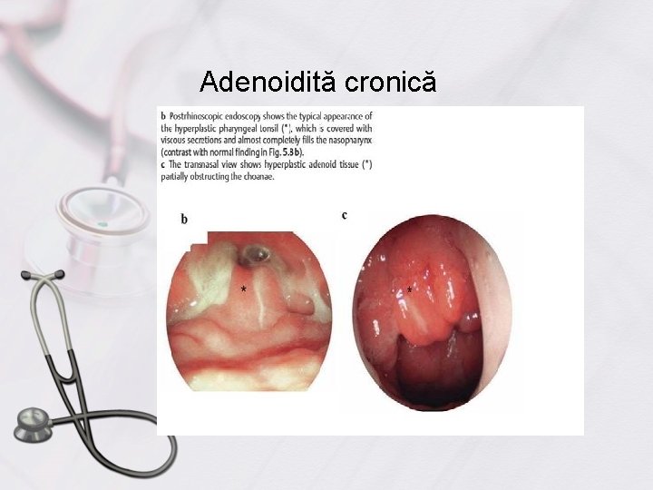 Adenoidită cronică 