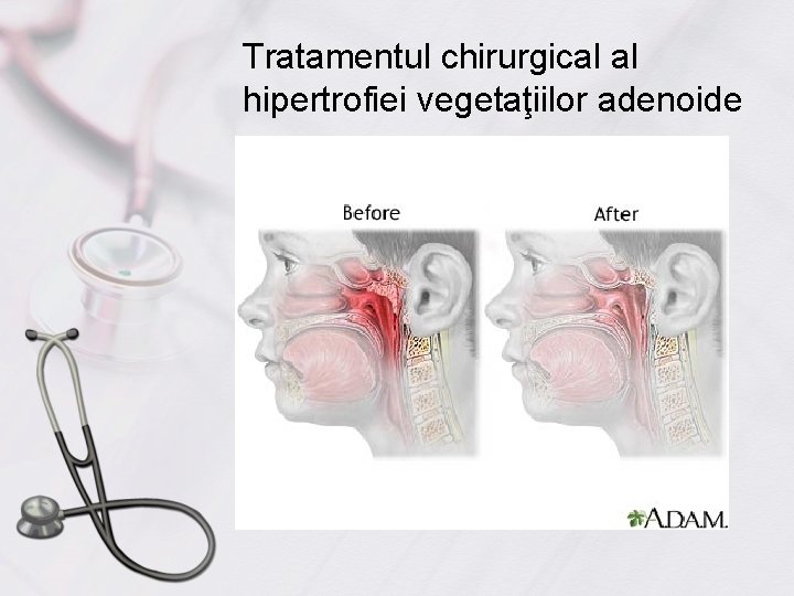 Tratamentul chirurgical al hipertrofiei vegetaţiilor adenoide 