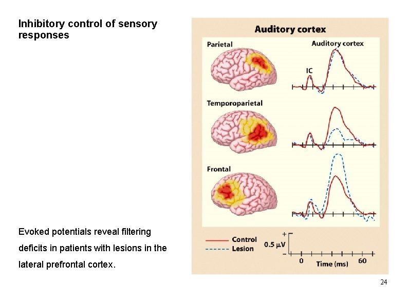 Inhibitory control of sensory responses Evoked potentials reveal filtering deficits in patients with lesions
