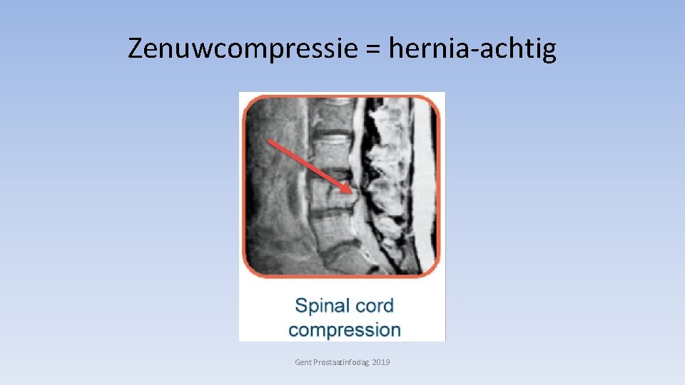 Zenuwcompressie = hernia-achtig Gent Prostaatinfodag 2019 