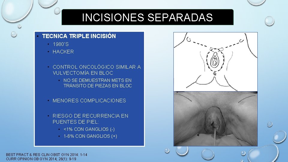 INCISIONES SEPARADAS • TECNICA TRIPLE INCISIÓN • 1980’S • HACKER • CONTROL ONCOLÓGICO SIMILAR