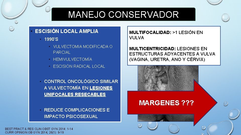 MANEJO CONSERVADOR • ESCISIÓN LOCAL AMPLIA • 1990’S • VULVECTOMIA MODIFICADA O PARCIAL •