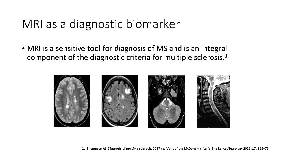 MRI as a diagnostic biomarker • MRI is a sensitive tool for diagnosis of