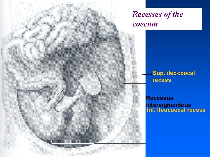 Recesses of the coecum Sup. ileocoecal recess Recessus intersigmoideus Inf. Ileocoecal recess 