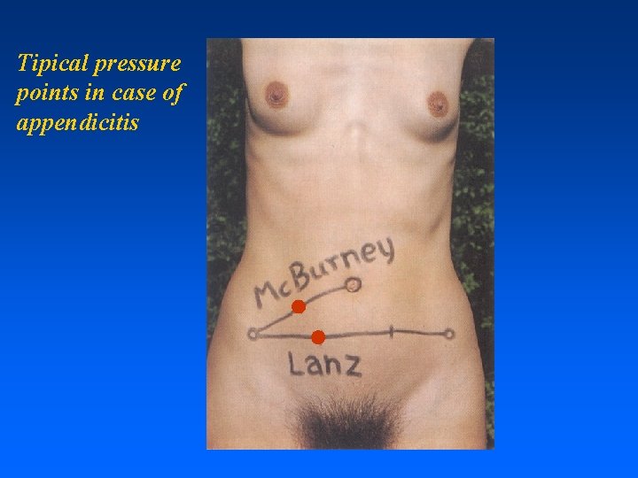 Tipical pressure points in case of appendicitis 