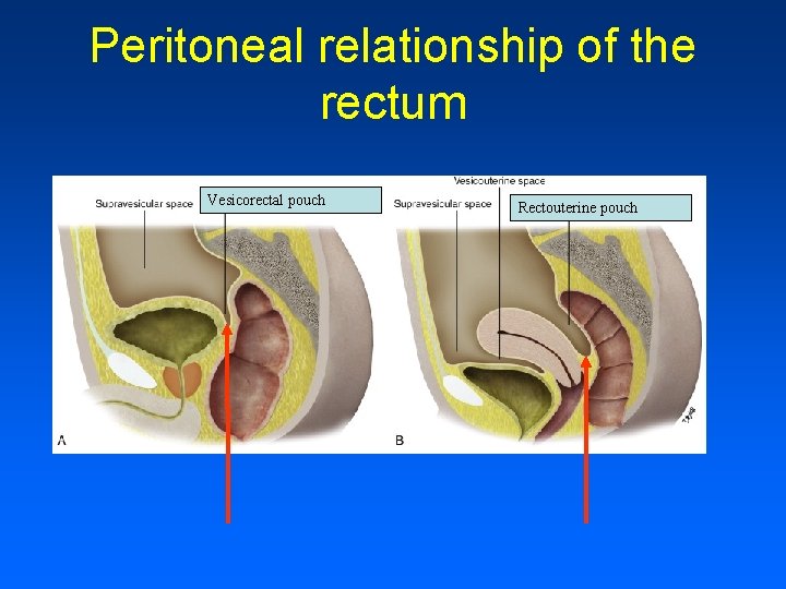 Peritoneal relationship of the rectum Vesicorectal pouch Rectouterine pouch 