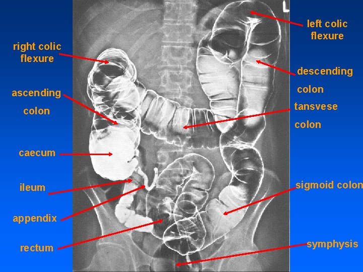 right colic flexure left colic flexure descending ascending colon tansvese colon caecum ileum sigmoid