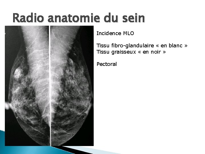 Radio anatomie du sein Incidence MLO Tissu fibro-glandulaire « en blanc » Tissu graisseux