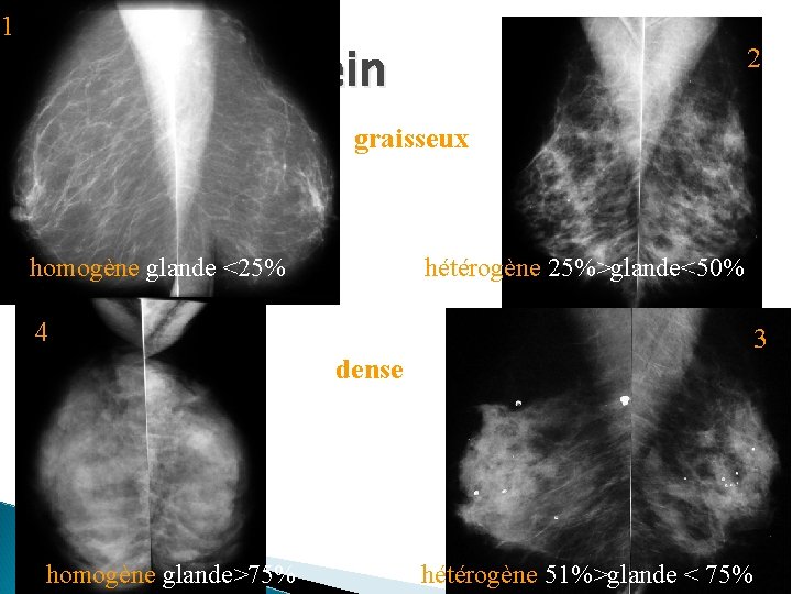 1 Densité du sein 2 graisseux homogène glande <25% hétérogène 25%>glande<50% 4 dense homogène