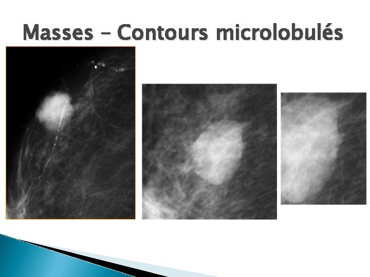 Masses – Contours microlobulés 