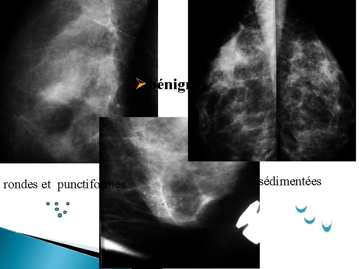 éparses Øbénignes rondes et punctiformes sédimentées 