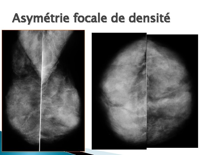 Asymétrie focale de densité 