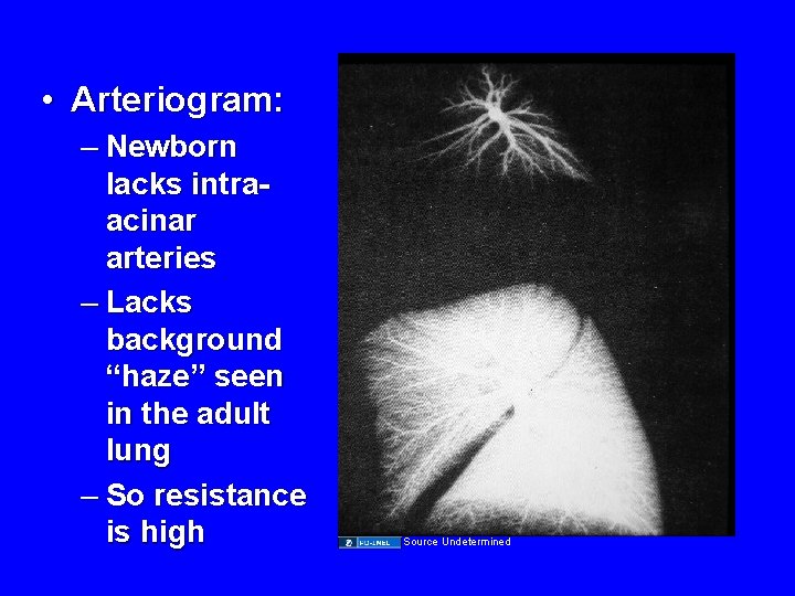  • Arteriogram: – Newborn lacks intraacinar arteries – Lacks background “haze” seen in