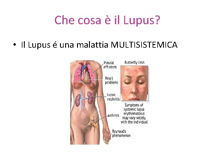 Che cosa è il Lupus? • Il Lupus é una malattia MULTISISTEMICA 