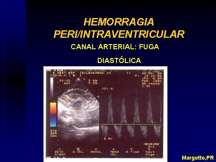 HEMORRAGIA PERI/INTRAVENTRICULAR CANAL ARTERIAL: FUGA DIASTÓLICA Margotto, PR 