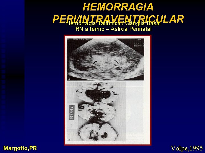 HEMORRAGIA PERI/INTRAVENTRICULAR Hemorragia Talâmica / Gânglia Basal RN a termo – Asfixia Perinatal Margotto,