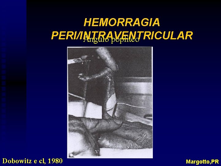HEMORRAGIA PERI/INTRAVENTRICULAR ngulo poplíteo Dobowitz e cl, 1980 Margotto, PR 
