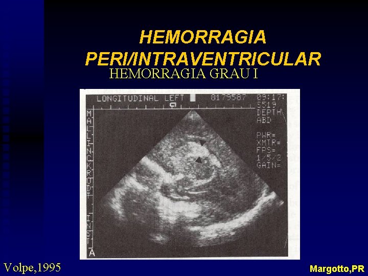 HEMORRAGIA PERI/INTRAVENTRICULAR HEMORRAGIA GRAU I Volpe, 1995 Margotto, PR 