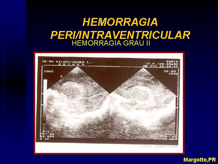 HEMORRAGIA PERI/INTRAVENTRICULAR HEMORRAGIA GRAU II Margotto, PR 