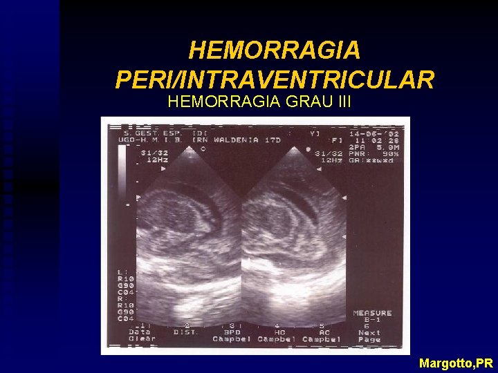 HEMORRAGIA PERI/INTRAVENTRICULAR HEMORRAGIA GRAU III Margotto, PR 