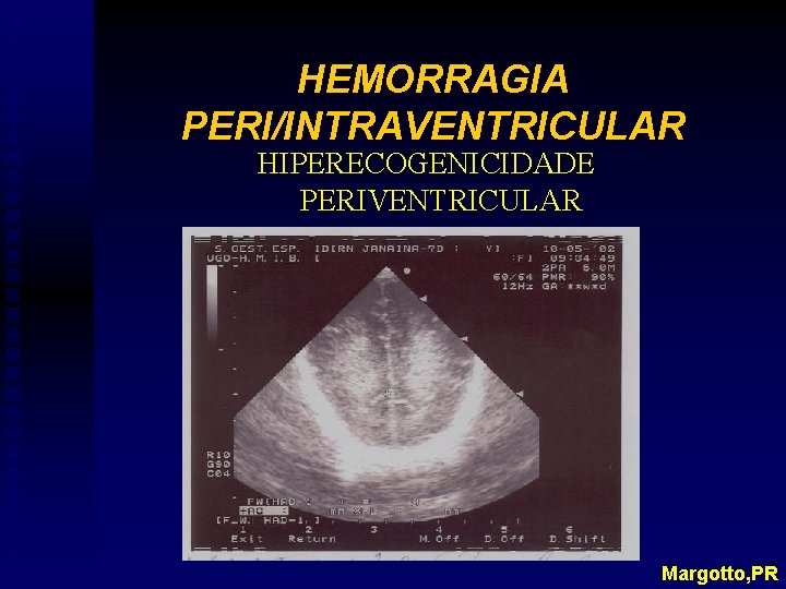 HEMORRAGIA PERI/INTRAVENTRICULAR HIPERECOGENICIDADE PERIVENTRICULAR Margotto, PR 