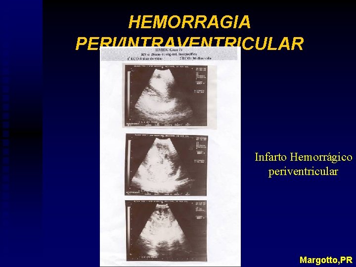 HEMORRAGIA PERI/INTRAVENTRICULAR Infarto Hemorrágico periventricular Margotto, PR 