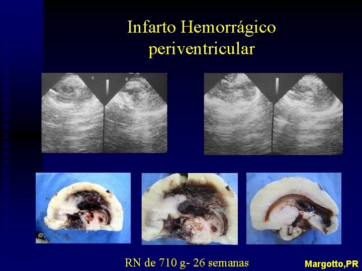Infarto Hemorrágico periventricular RN de 710 g- 26 semanas Margotto, PR 