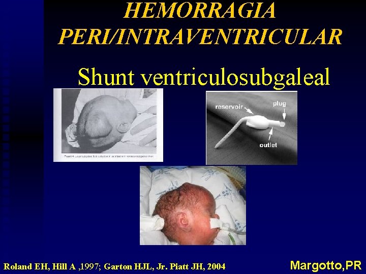 HEMORRAGIA PERI/INTRAVENTRICULAR Shunt ventriculosubgaleal Roland EH, Hill A , 1997; Garton HJL, Jr. Piatt