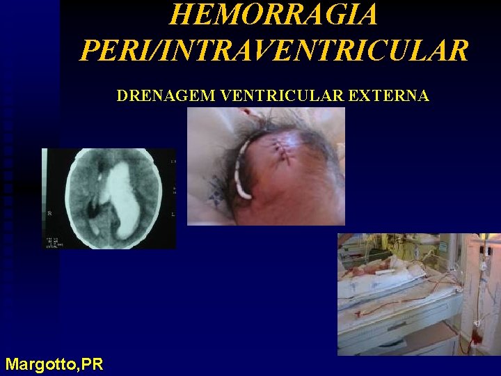 HEMORRAGIA PERI/INTRAVENTRICULAR DRENAGEM VENTRICULAR EXTERNA Margotto, PR 