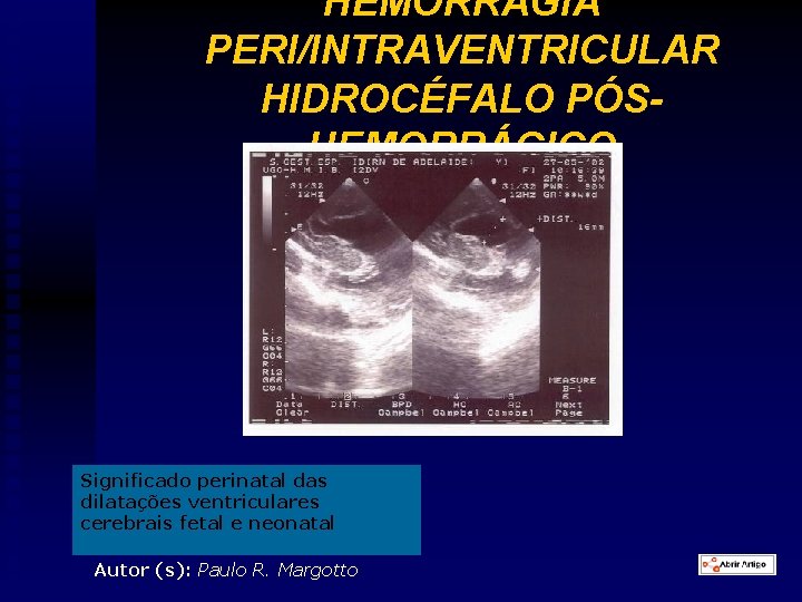 HEMORRAGIA PERI/INTRAVENTRICULAR HIDROCÉFALO PÓSHEMORRÁGICO Significado perinatal das dilatações ventriculares cerebrais fetal e neonatal Autor