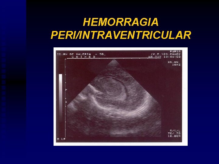 HEMORRAGIA PERI/INTRAVENTRICULAR 