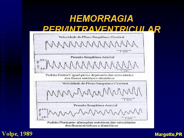 HEMORRAGIA PERI/INTRAVENTRICULAR Volpe, 1989 Margotto, PR 