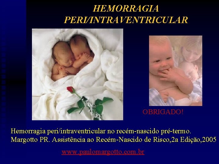 HEMORRAGIA PERI/INTRAVENTRICULAR OBRIGADO! Hemorragia peri/intraventricular no recém-nascido pré-termo. Margotto PR. Assistência ao Recém-Nascido de