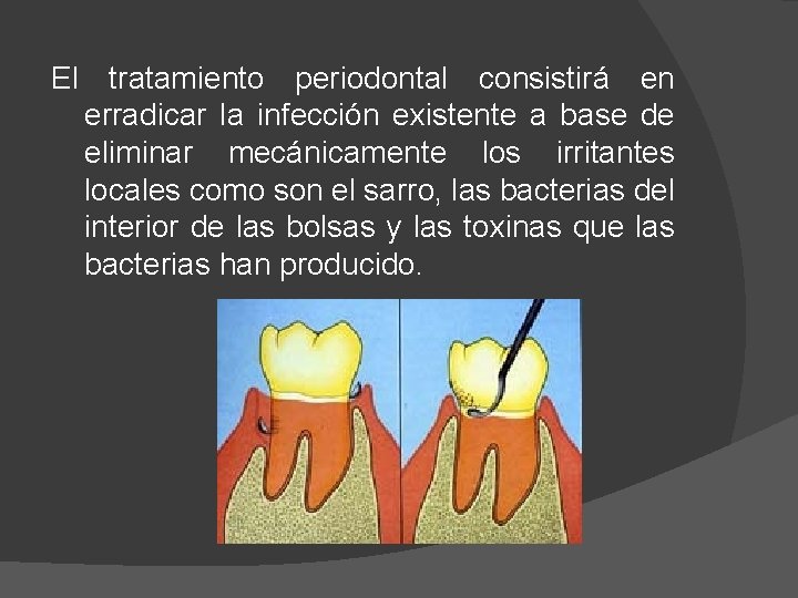 El tratamiento periodontal consistirá en erradicar la infección existente a base de eliminar mecánicamente