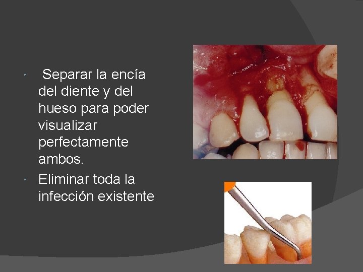  Separar la encía del diente y del hueso para poder visualizar perfectamente ambos.