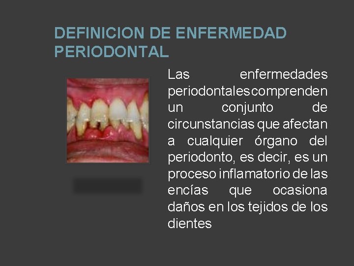 DEFINICION DE ENFERMEDAD PERIODONTAL Las enfermedades periodontales comprenden un conjunto de circunstancias que afectan