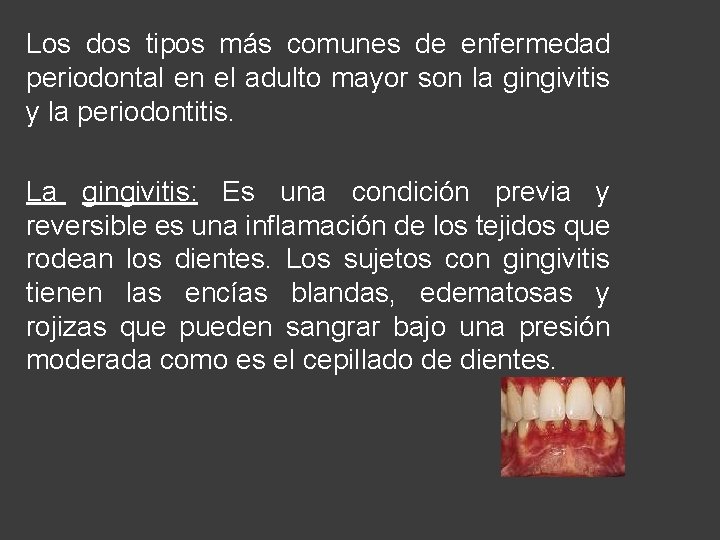 Los dos tipos más comunes de enfermedad periodontal en el adulto mayor son la