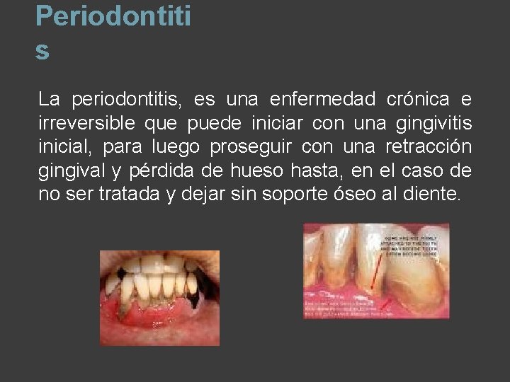 Periodontiti s La periodontitis, es una enfermedad crónica e irreversible que puede iniciar con