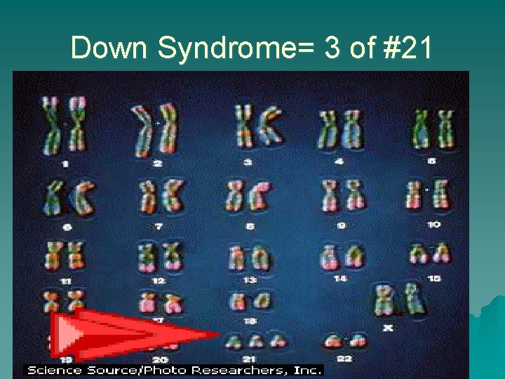 Down Syndrome= 3 of #21 Down Syndrome= 3 of #21