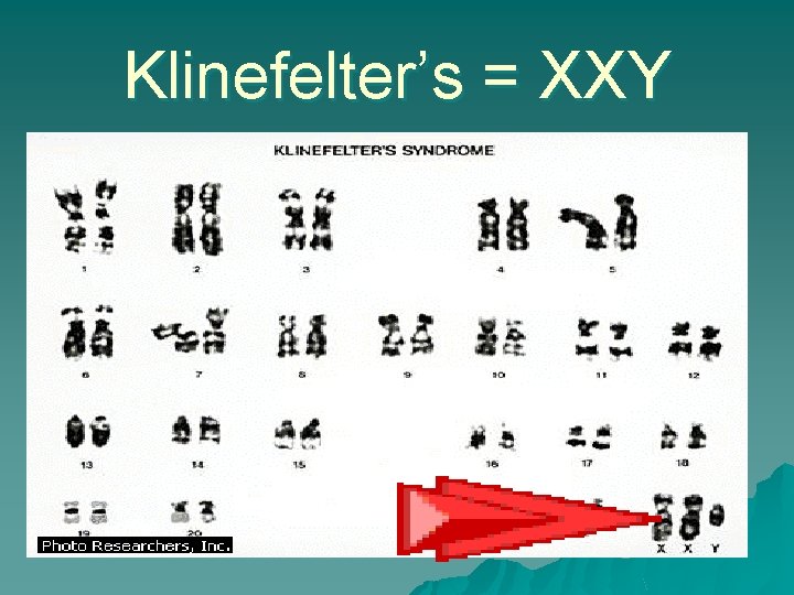 Klinefelter’s = XXY Klinefelter’s = XXY