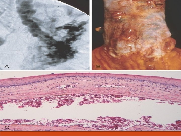 Complications of liver cirrhosis 