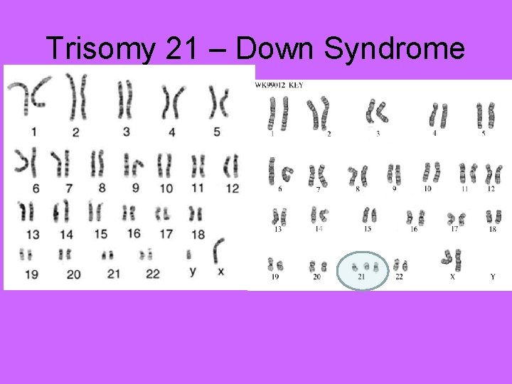 Trisomy 21 – Down Syndrome 