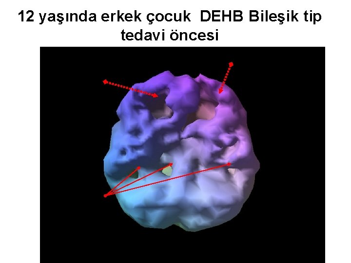12 yaşında erkek çocuk DEHB Bileşik tip tedavi öncesi Prof. Dr. Ayşe Avcı Gaziantep