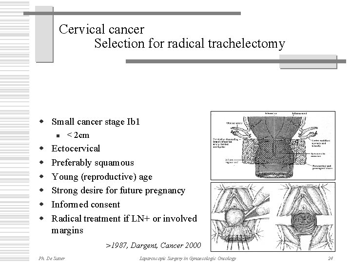 Cervical cancer Selection for radical trachelectomy w Small cancer stage Ib 1 n w