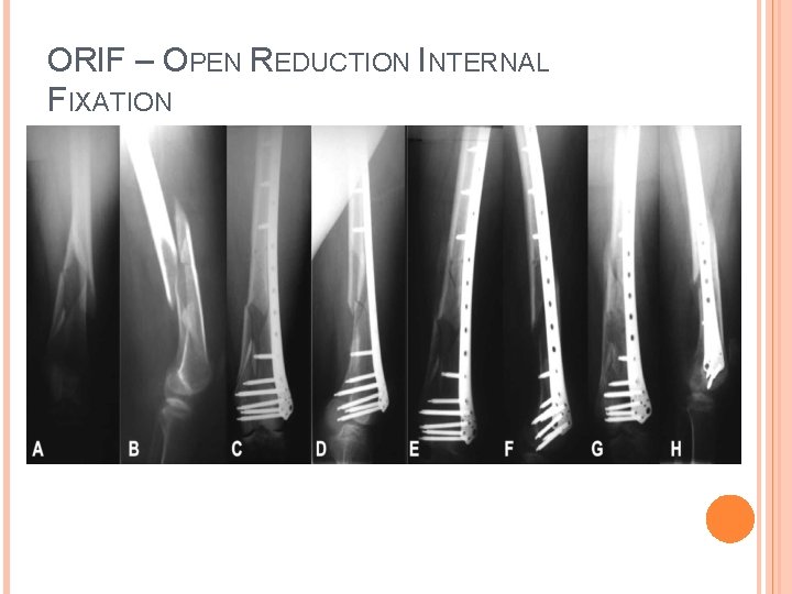 ORIF – OPEN REDUCTION INTERNAL FIXATION 