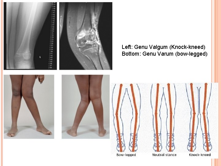 Left: Genu Valgum (Knock-kneed) Bottom: Genu Varum (bow-legged) 