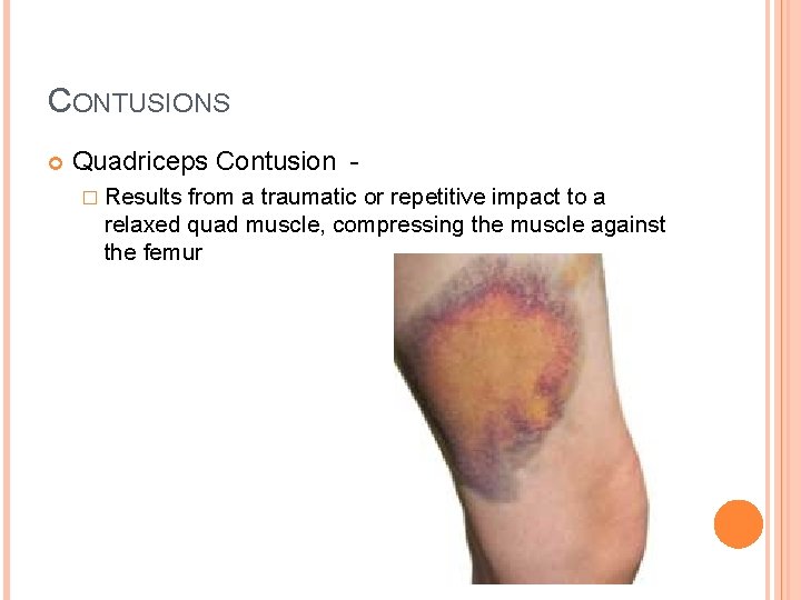 CONTUSIONS Quadriceps Contusion � Results from a traumatic or repetitive impact to a relaxed