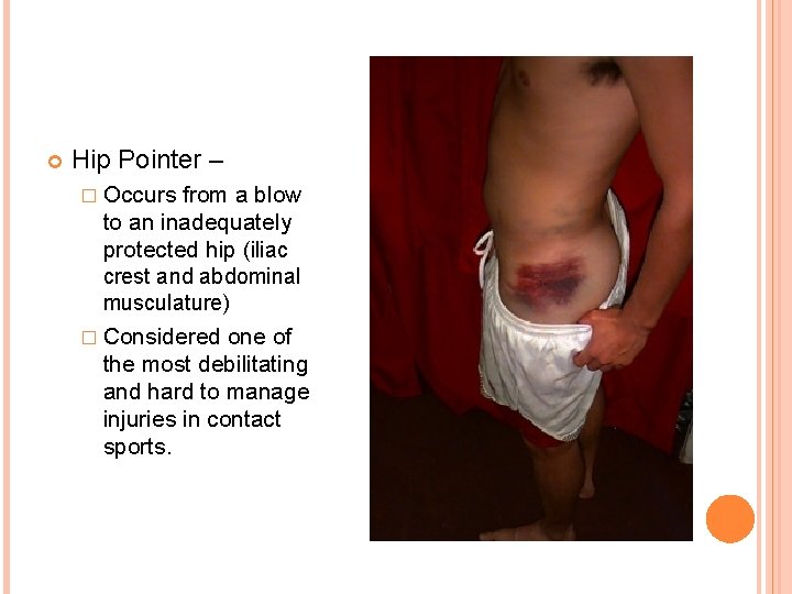  Hip Pointer – � Occurs from a blow to an inadequately protected hip