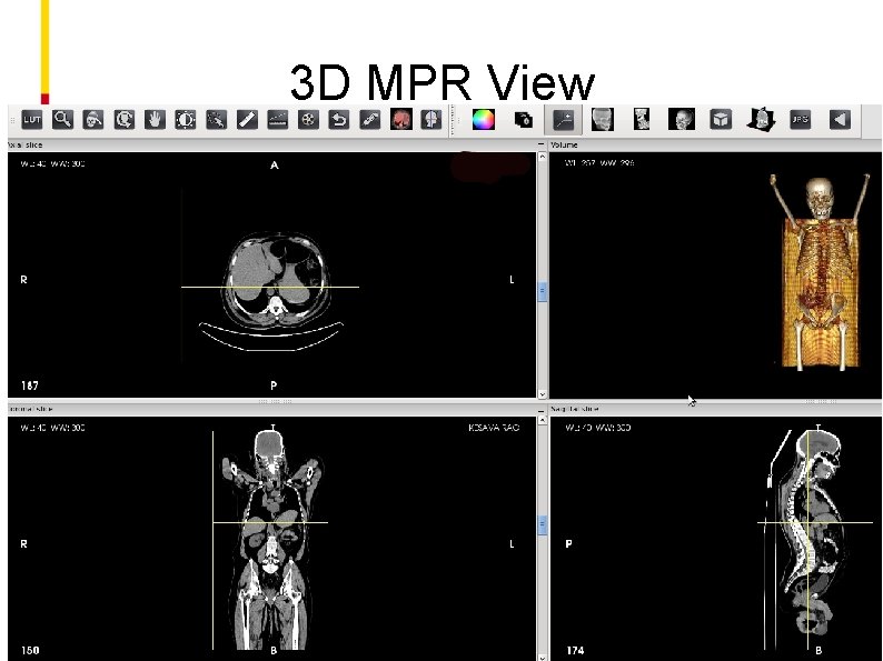 3 D MPR View 